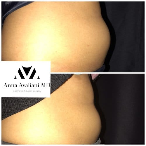 SculpSure before and after, result 13