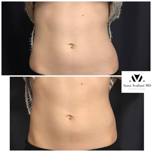 SculpSure before and after, result 14
