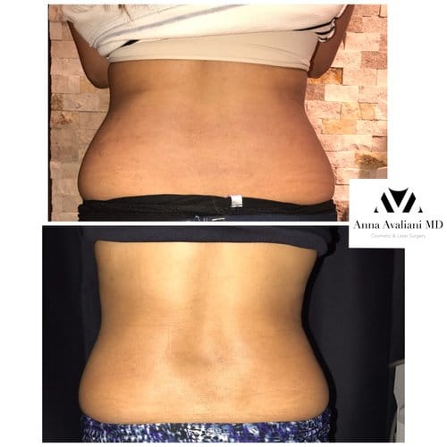 SculpSure before and after