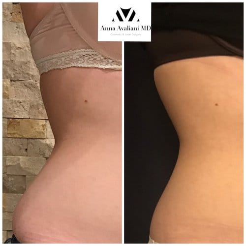 SculpSure before and after, result 3