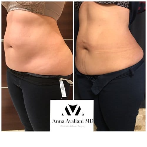 SculpSure before and after, result 4
