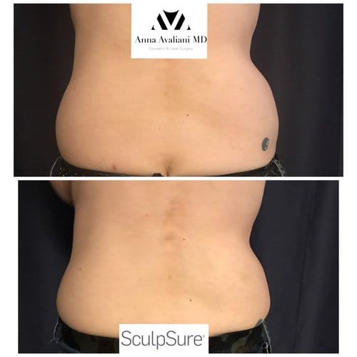 SculpSure before and after, result 5