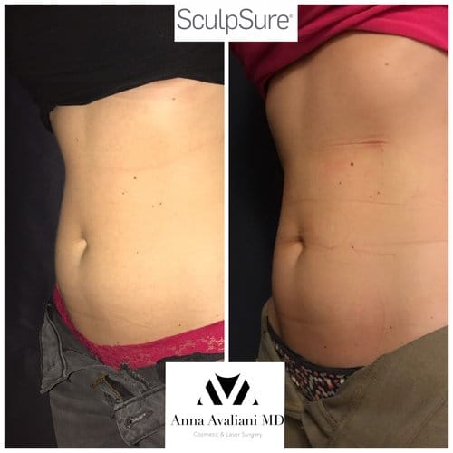 SculpSure before and after, result 6