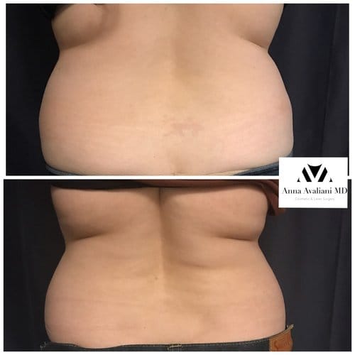 SculpSure before and after, result 7