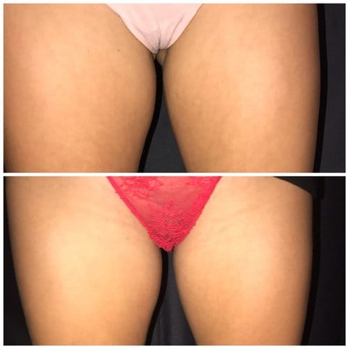 SculpSure before and after, result 8