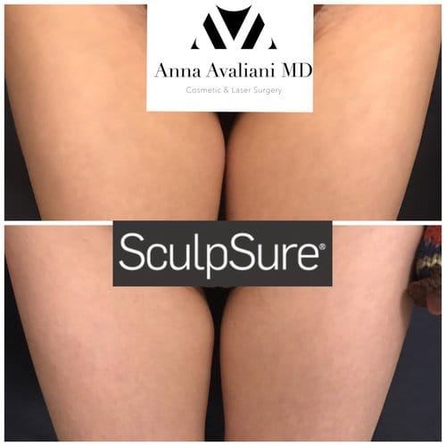SculpSure before and after, result 9