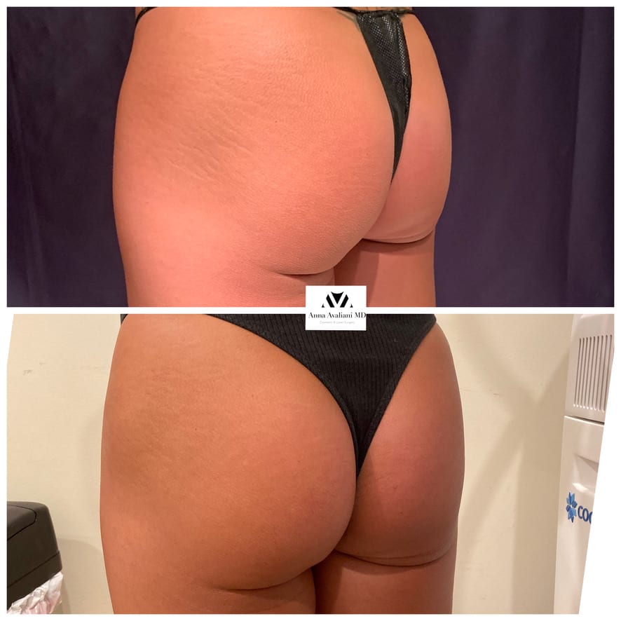 Sculptra butt lift back view before and after, Dr. Avaliani NYC