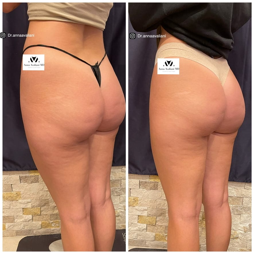 Sculptra butt lift back view before and after, Dr. Avaliani NYC