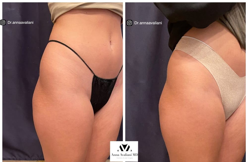 Sculptra butt lift hips before and after, Dr. Avaliani NYC