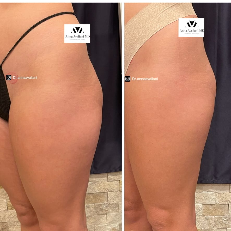 Sculptra butt lift side view before and after, Dr. Avaliani NYC