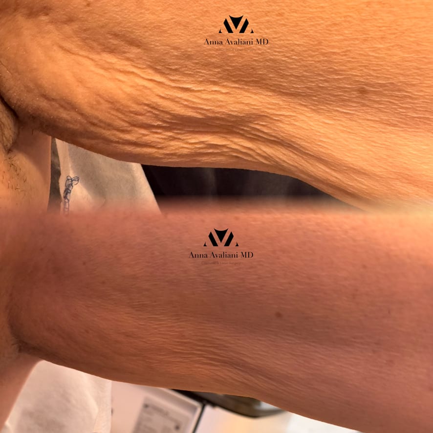 Sculptra elbows before and after, Dr. Avaliani NYC