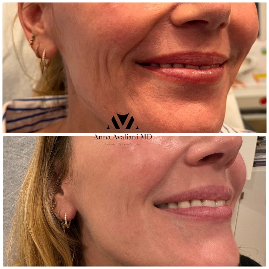 Sculptra face cheeks before and after, Dr. Avaliani NYC