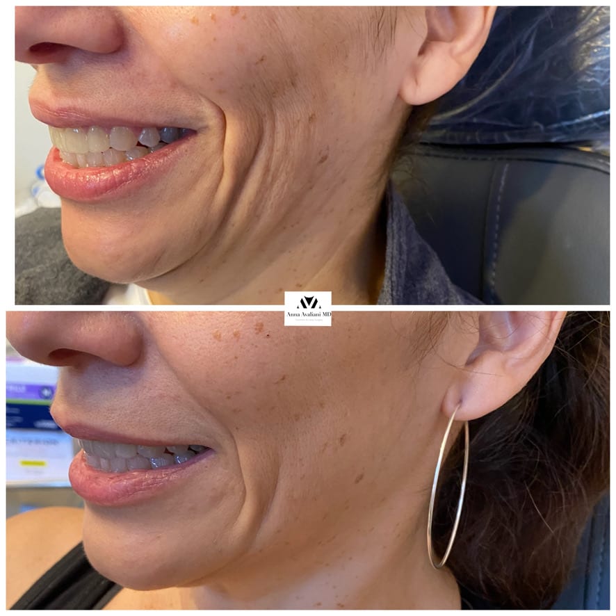 Sculptra face cheeks smile lines before and after, Dr. Avaliani NYC