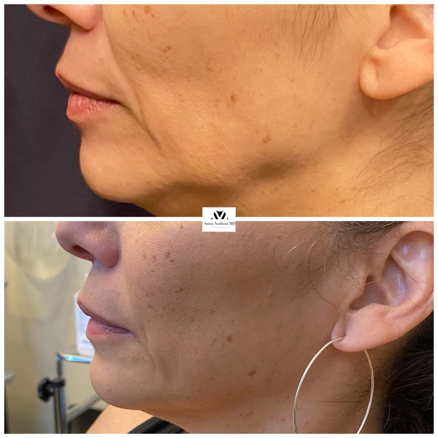 Sculptra face jawline before and after, Dr. Avaliani NYC