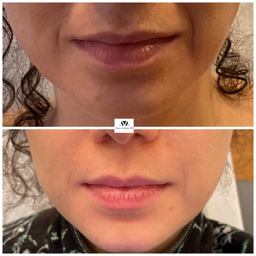 Sculptra face lower face before and after, Dr. Avaliani NYC
