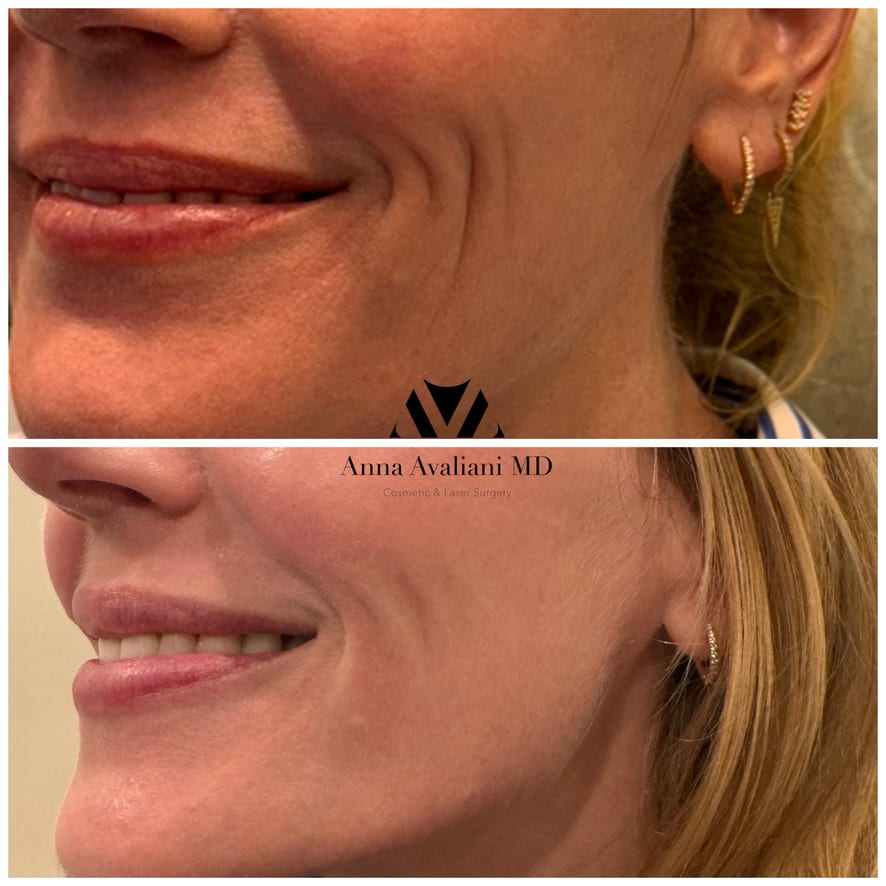 Sculptra face smile lines before and after, Dr. Avaliani NYC