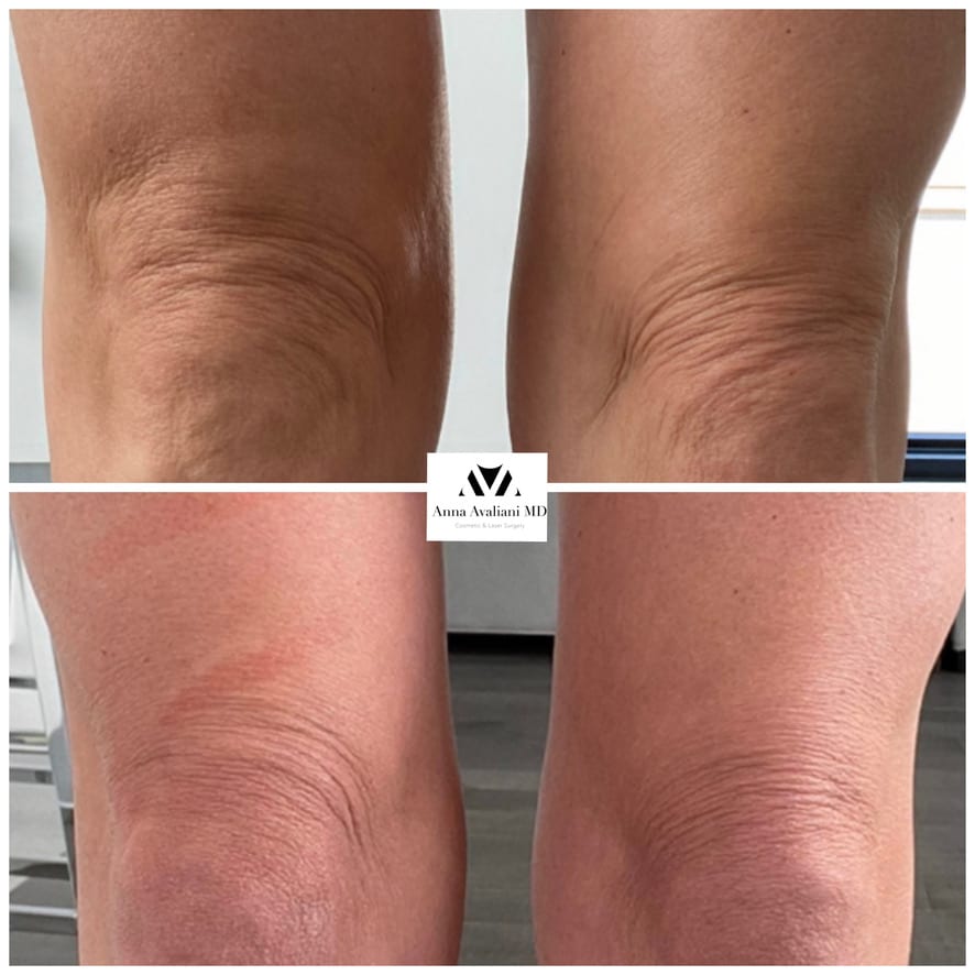 Sculptra knees before and after, Dr. Avaliani NYC