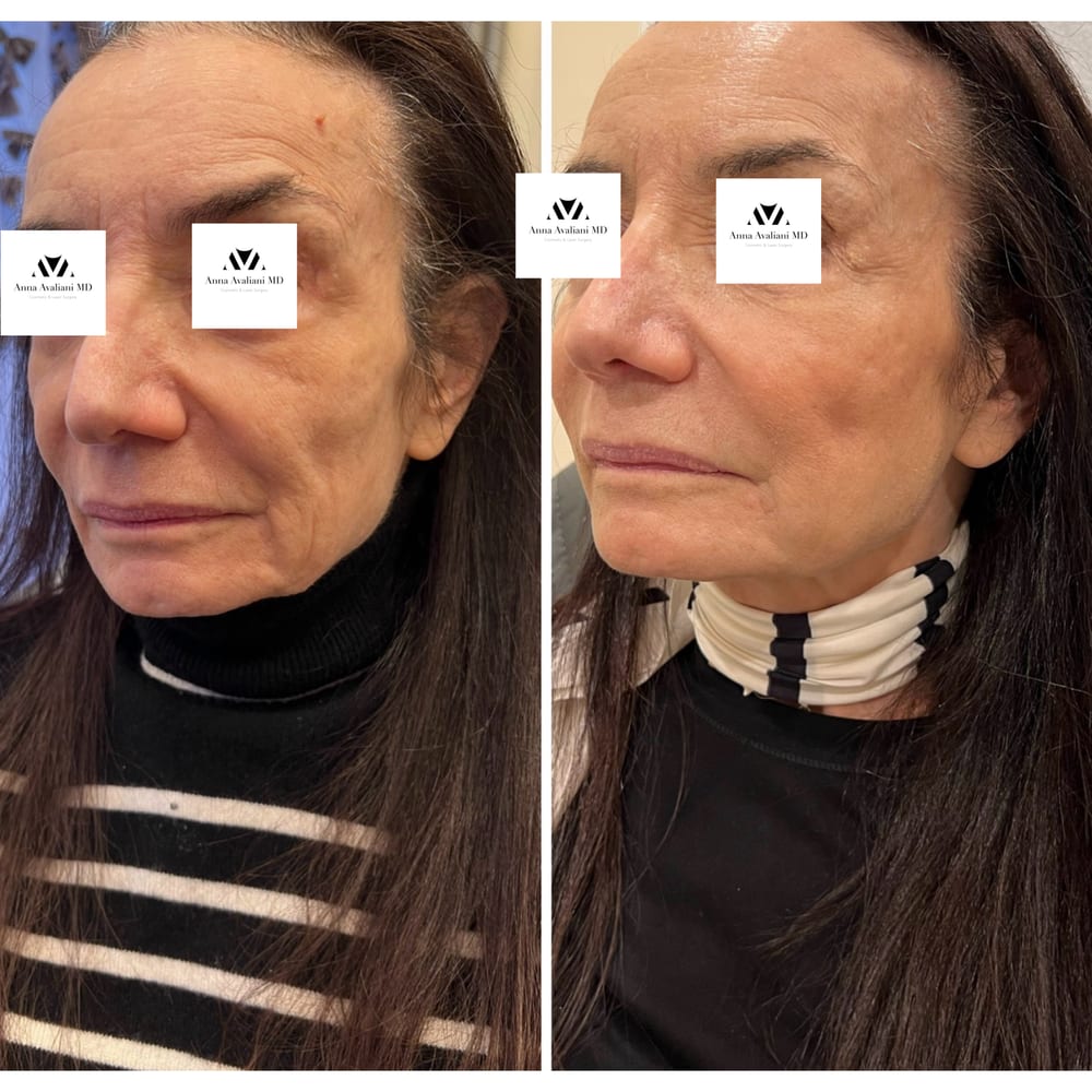 Ozempic Face before and after