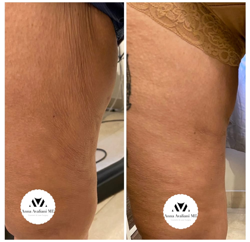 Sculptra thigh cellulite before and after, Dr. Avaliani NYC