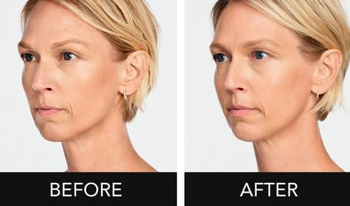 Radiesse before and after, result 2