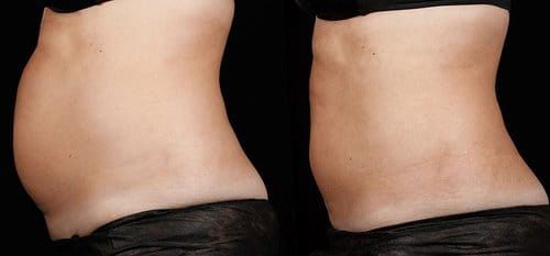 SculpSure before and after, result 19