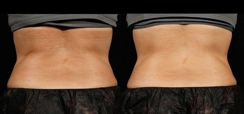 SculpSure before and after, result 18