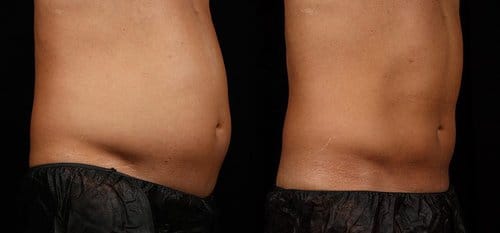 SculpSure before and after, result 17
