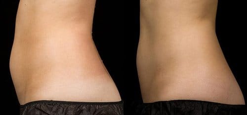 SculpSure before and after, result 15