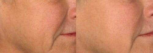 PicoSure / Laser Skin Rejuvenation before and after, result 55