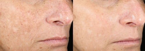 PicoSure / Laser Skin Rejuvenation before and after, result 63