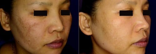PicoSure / Laser Skin Rejuvenation before and after, result 56