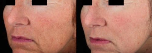 PicoSure / Laser Skin Rejuvenation before and after, result 57