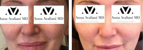 PicoSure / Laser Skin Rejuvenation before and after, result 54