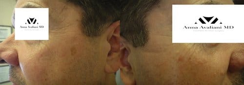 PicoSure / Laser Skin Rejuvenation before and after, result 53
