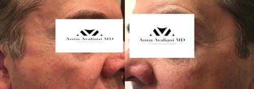 PicoSure / Laser Skin Rejuvenation before and after, result 52