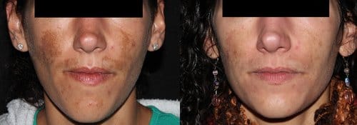 PicoSure / Laser Skin Rejuvenation before and after, result 58