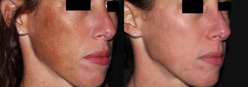 PicoSure / Laser Skin Rejuvenation before and after, result 59