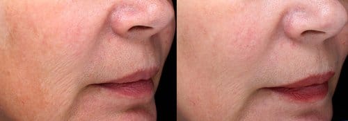 PicoSure / Laser Skin Rejuvenation before and after, result 60