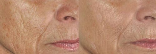 PicoSure / Laser Skin Rejuvenation before and after, result 61