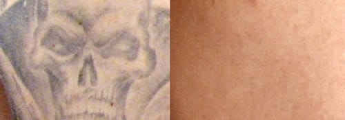 Tattoo Removal before and after, result 1