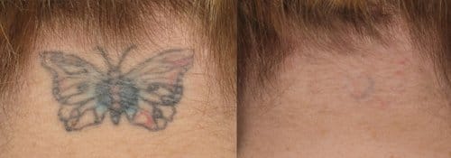 Tattoo Removal before and after, result 2