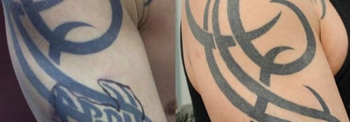 Tattoo Removal before and after, result 3