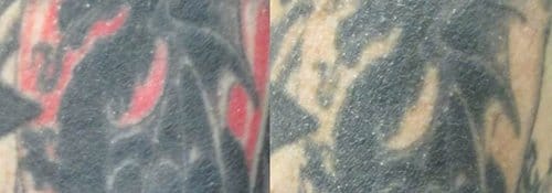 Tattoo Removal before and after, result 4