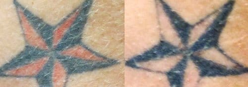 Tattoo Removal before and after, result 5
