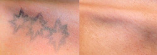 Tattoo Removal before and after, result 6