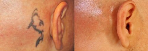 Tattoo Removal before and after, result 7