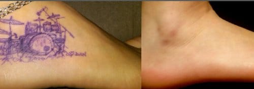 Tattoo Removal before and after, result 8