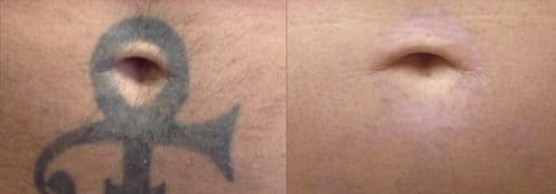 Tattoo Removal before and after, result 9