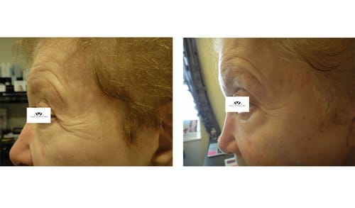 Ulthera before and after, result 12