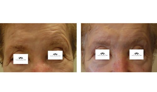 Ulthera before and after, result 13
